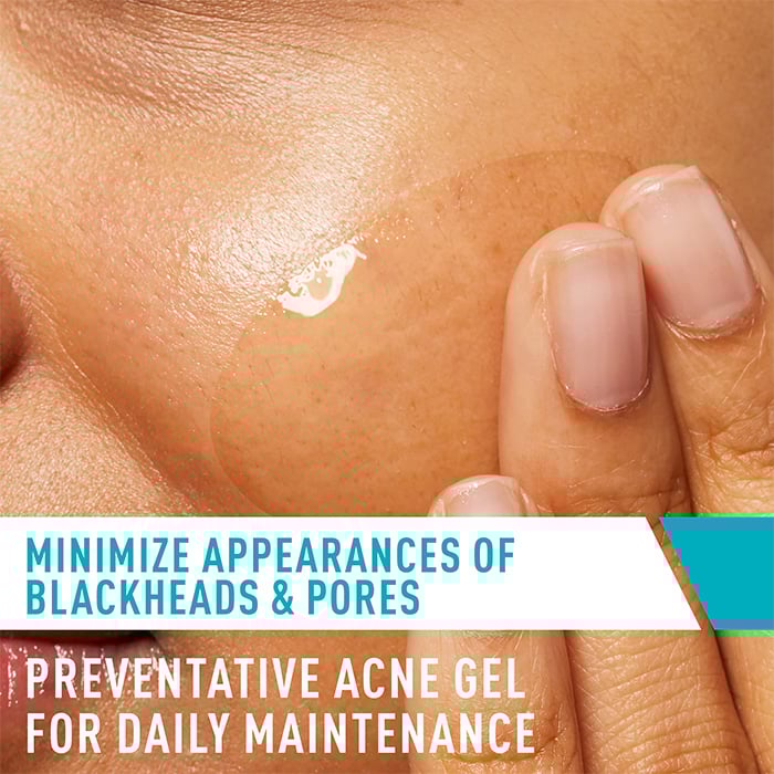 Acne Control Gel - Image 4