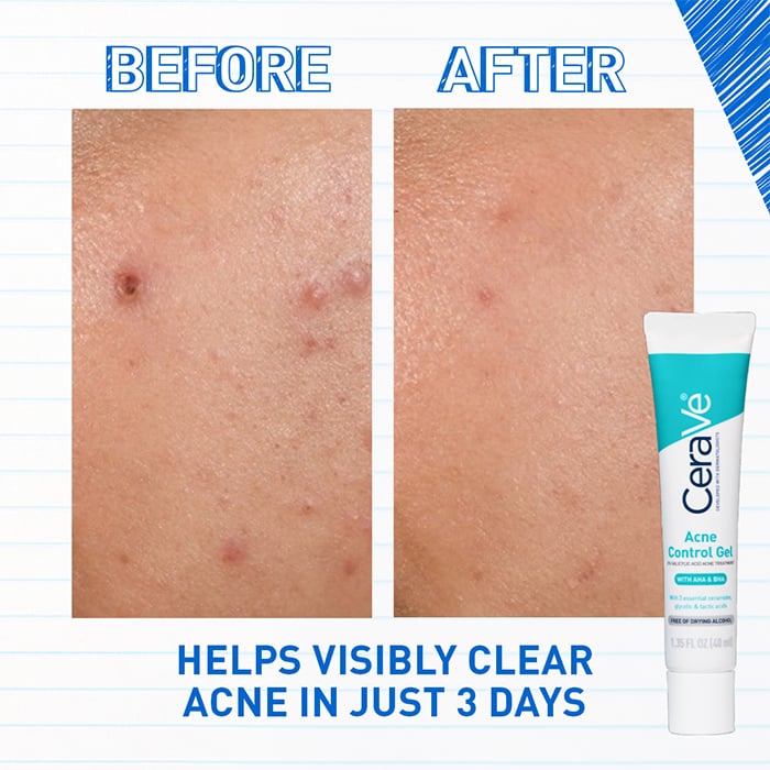 Acne Control Gel - Image 3