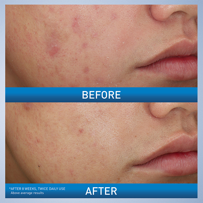 Acne Foaming Cream Wash - Image 3